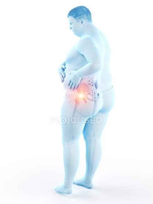 Silhueta de homem obeso com dor no quadril, ilustração digital . — Fotografia de Stock