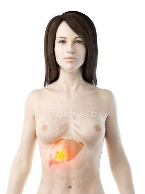 Рак печени в реалистичной анатомической женской модели, концептуальная компьютерная иллюстрация
. — стоковое фото