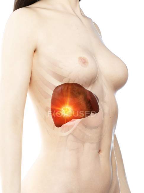 Cancer du foie dans un modèle féminin anatomique réaliste, illustration conceptuelle par ordinateur
. — Photo de stock