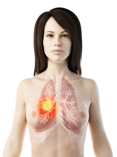 Рак легень у жіночій реалістичній моделі тіла 3d, концептуальний комп'ютерний малюнок. — стокове фото
