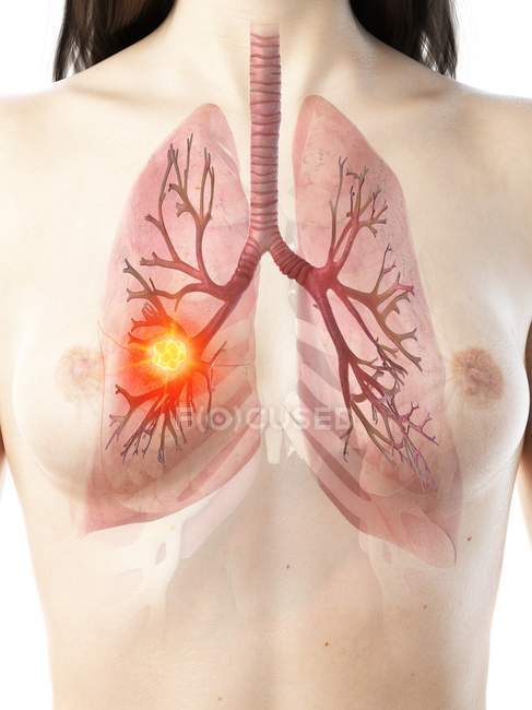 Lungenkrebs im weiblichen Körper 3D-Modell, konzeptionelle Computerillustration. — Stockfoto