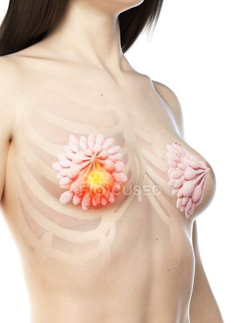 Corps abstrait féminin avec cancer du sein éclatant, illustration conceptuelle par ordinateur
. — Photo de stock