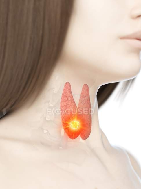 Рак щитовидної залози у жіночому тілі, концептуальна комп'ютерна ілюстрація . — стокове фото