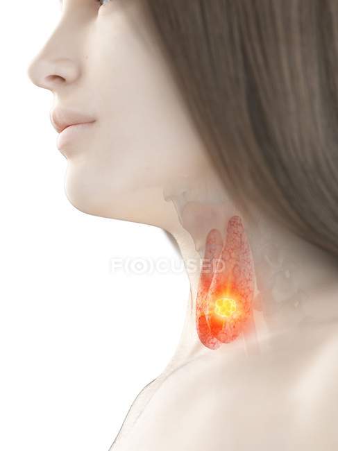 Рак щитовидної залози в жіночому тілі, концептуальний комп'ютерний приклад. — стокове фото