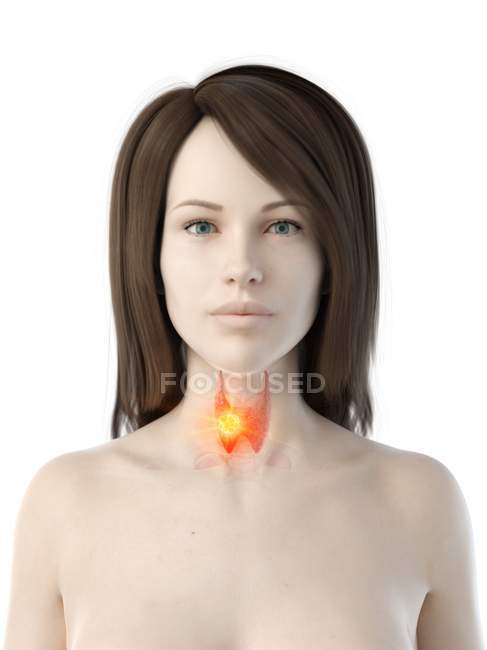 Рак щитовидної залози в жіночому тілі, концептуальний комп'ютерний приклад. — стокове фото