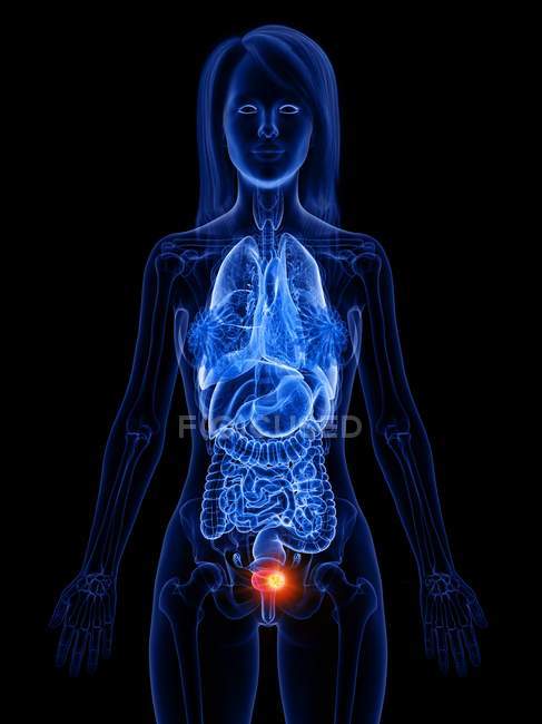 Blasenkrebs im menschlichen Körper Silhouette, konzeptionelle digitale Illustration. — Stockfoto