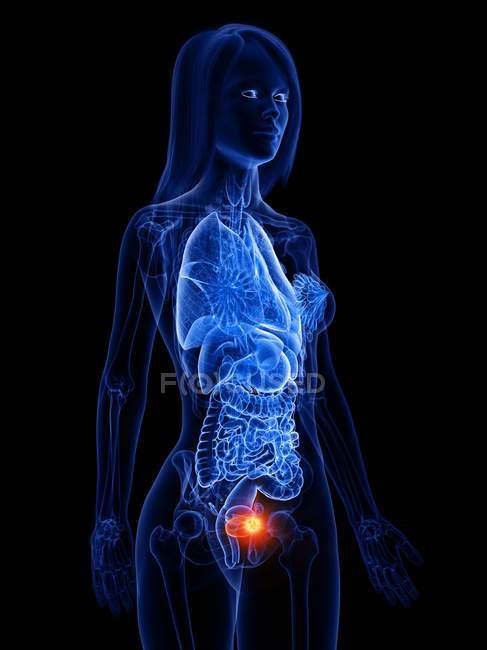 Bladder cancer in human body silhouette, conceptual digital illustration. — Stock Photo