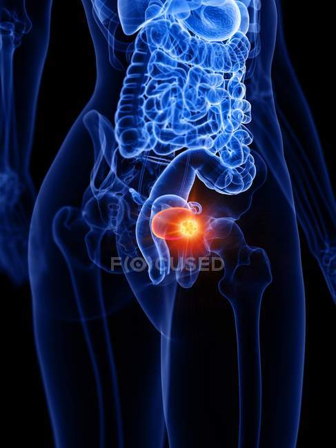Рак сечового міхура в силуеті людського тіла, концептуальний цифровий приклад. — стокове фото