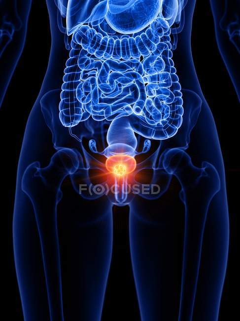 Cancro alla vescica nella silhouette del corpo umano, illustrazione digitale concettuale . — Foto stock
