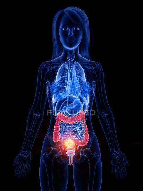 Рак кишечника у жіночому тілі, концептуальна комп'ютерна ілюстрація . — стокове фото
