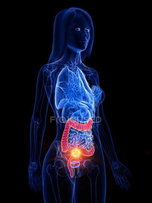 Cancro intestinale nel corpo femminile, illustrazione concettuale del computer
. — Foto stock