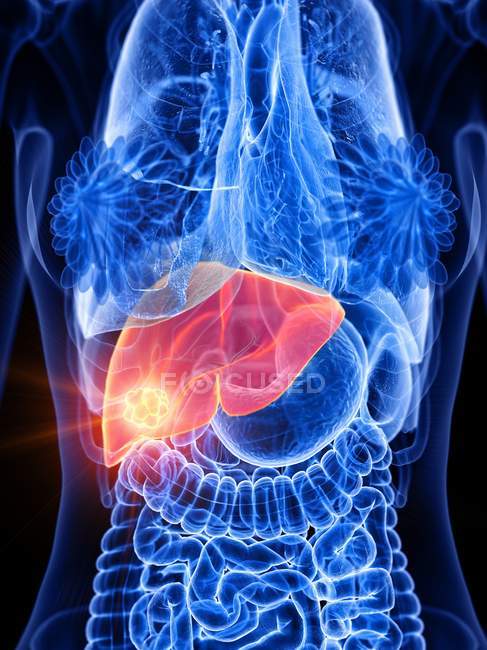 Câncer de fígado em corpo feminino abstrato, ilustração conceitual do computador . — Fotografia de Stock