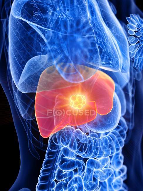 Câncer de fígado em corpo feminino abstrato, ilustração conceitual do computador . — Fotografia de Stock