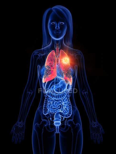 Рак легких у женщин прозрачный, концептуальная компьютерная иллюстрация
. — стоковое фото