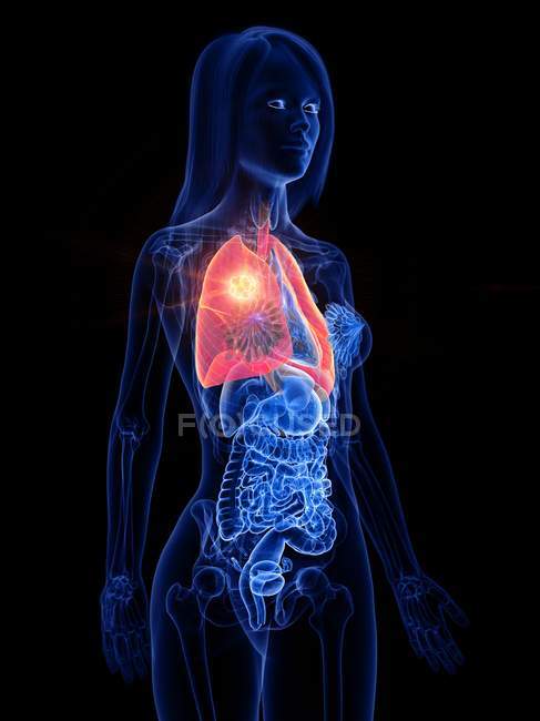Cáncer de pulmón en el cuerpo transparente femenino, ilustración conceptual por computadora
. - foto de stock