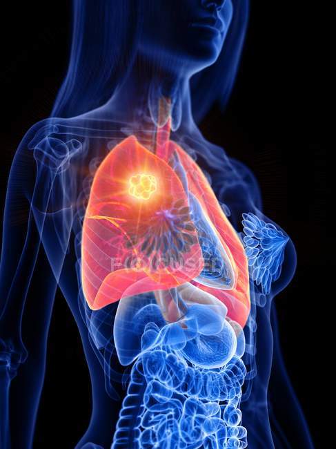 Lungenkrebs im transparenten Körper der Frau, konzeptionelle Computerillustration. — Stockfoto