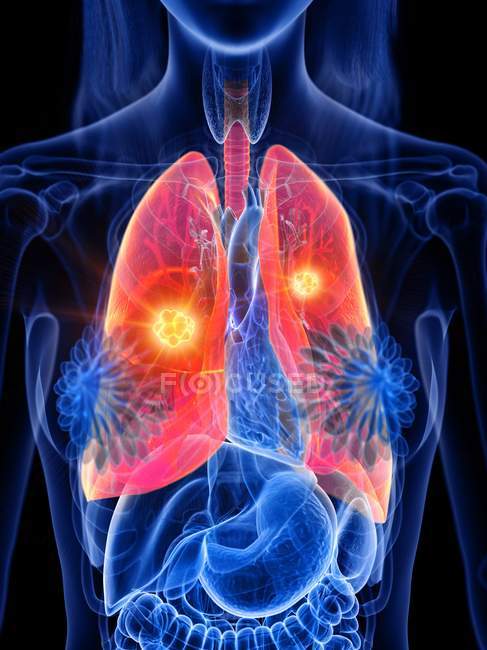 Cancer du poumon dans le corps transparent féminin, illustration conceptuelle par ordinateur
. — Photo de stock