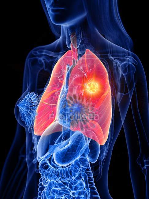 Lungenkrebs im transparenten Körper der Frau, konzeptionelle Computerillustration. — Stockfoto