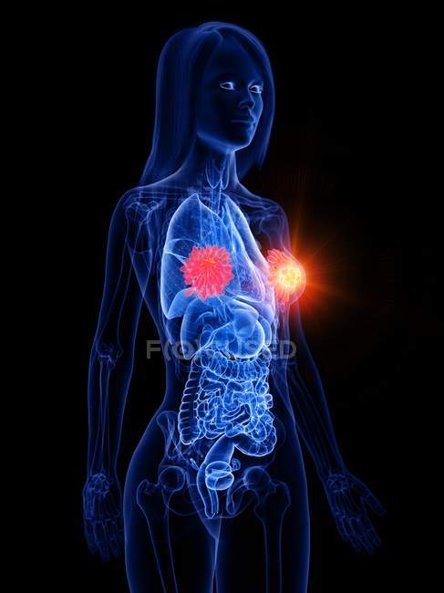 Женское абстрактное тело с сияющим раком молочной железы, концептуальная компьютерная иллюстрация . — стоковое фото