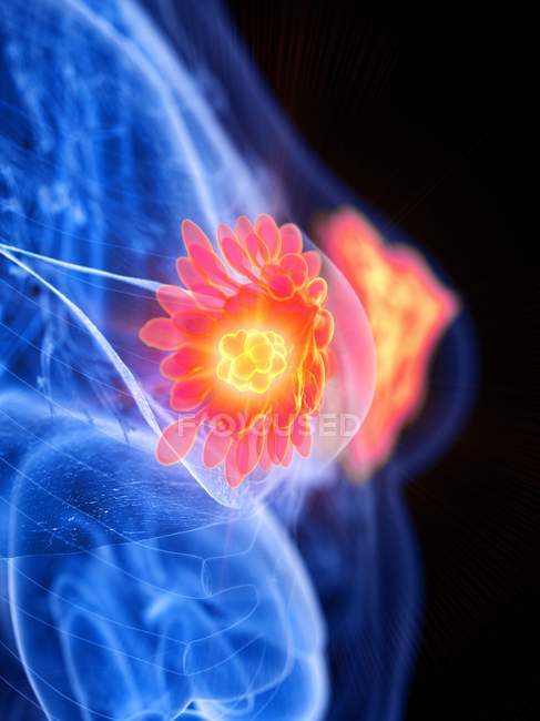 Female abstract body with glowing breast cancer, conceptual computer illustration. — Stock Photo