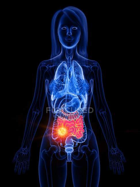 Intestino tenue e cancro intestinale nel corpo femminile, illustrazione concettuale del computer
. — Foto stock
