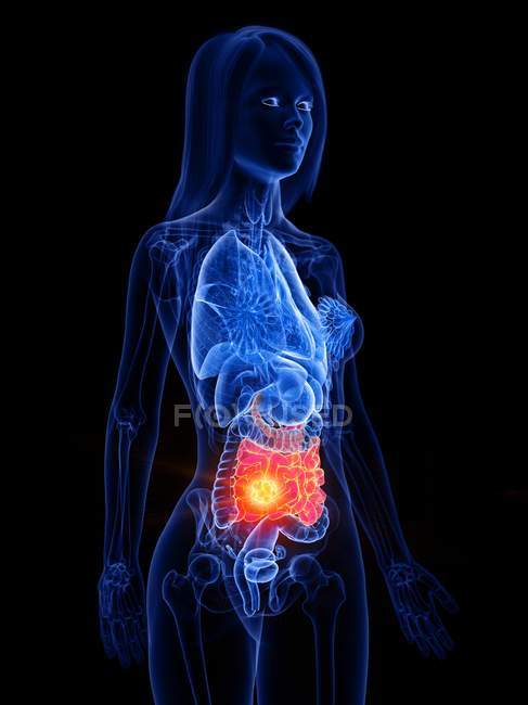 Cancro do intestino delgado e intestino no corpo feminino, ilustração conceitual do computador . — Fotografia de Stock
