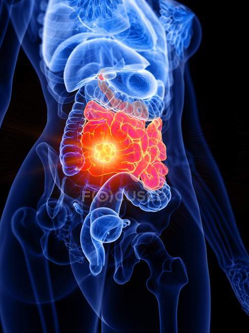 Рак тонкой кишки и кишечника в женском теле, концептуальная компьютерная иллюстрация . — стоковое фото