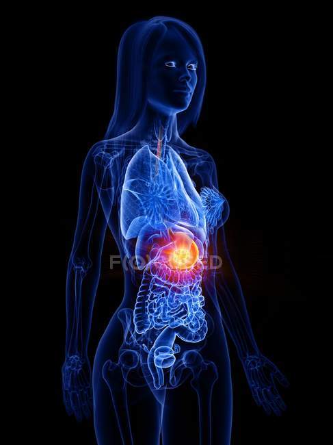 Cancro allo stomaco nel corpo femminile, illustrazione concettuale del computer
. — Foto stock