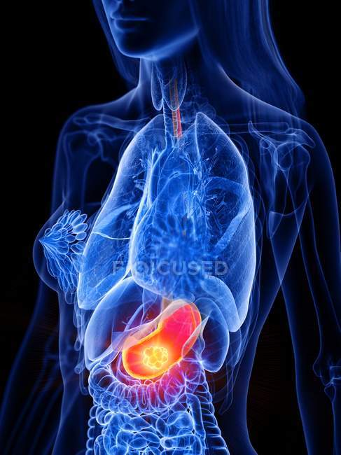 Cancer de l'estomac dans le corps féminin, illustration conceptuelle par ordinateur . — Photo de stock