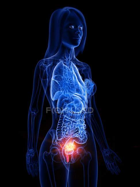 Cancro uterino nel corpo femminile, illustrazione concettuale del computer
. — Foto stock