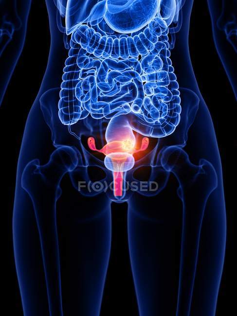 Рак яєчників у жіночому тілі, концептуальна комп'ютерна ілюстрація . — стокове фото