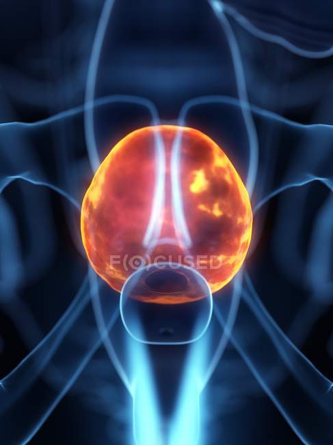 Diseased bladder in abstract human body, conceptual digital illustration. — Stock Photo