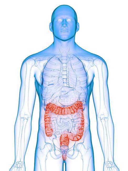 Corpo masculino com cólon doente, ilustração computacional . — Fotografia de Stock