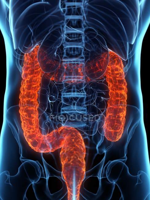 Cuerpo masculino con colon enfermo, ilustración por computadora
. - foto de stock