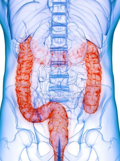 Male body with diseased colon, computer illustration. — Stock Photo