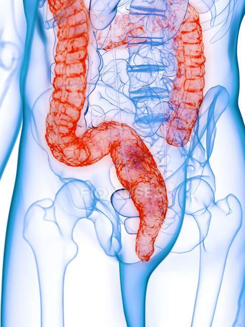 Cuerpo masculino con colon enfermo, ilustración por computadora . - foto de stock