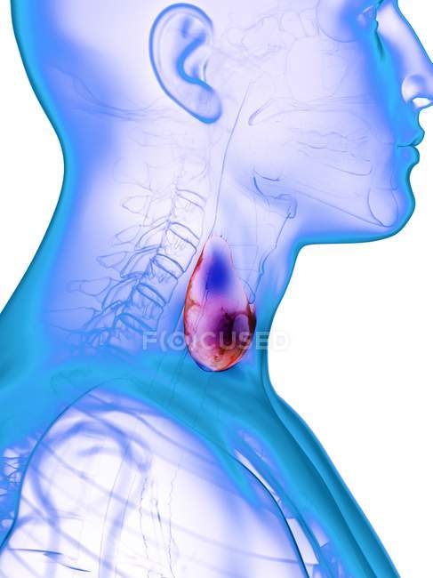 Silueta masculina con glándula tiroides enferma, ilustración conceptual . - foto de stock