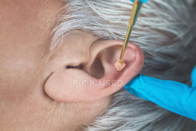 Auriculoterapia, o tratamiento auricular en el oído humano con masaje flexible lápiz de oído de latón, de cerca. Presión de acupuntura en la etiqueta de semillas . - foto de stock