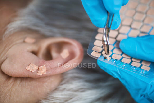 Auriculoterapia, o tratamiento auricular en el oído humano, de cerca. Mano del terapeuta aplicando adhesivo de semilla de oreja de acupuntura con pinzas. - foto de stock