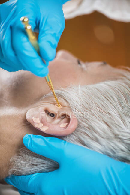 L'auriculothérapie, ou traitement auriculaire sur l'oreille humaine, se referme. La main du thérapeute applique un autocollant acupuncture épi avec une pince à épiler. — Photo de stock