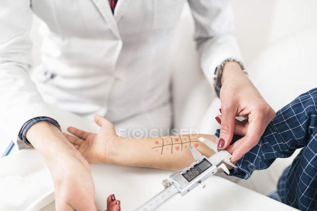 Médecin femme mesurant avec étriers réaction allergique pendant le test de piqûre de peau
. — Photo de stock