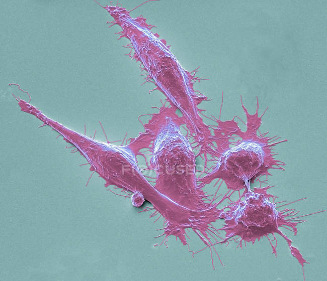 Micrógrafo electrónico de barrido coloreado de células cancerosas del colon . - foto de stock