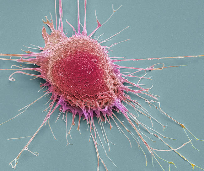 Célula cancerosa de próstata, micrografía electrónica de barrido coloreada
. - foto de stock