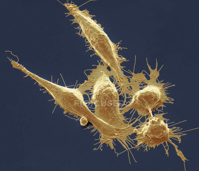 Цветной сканирующий электронный микрограф раковых клеток толстой кишки . — стоковое фото