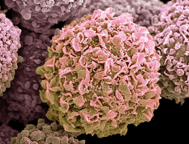 Кольоровий скануючий електронний мікрограф клітин раку молочної залози.. — стокове фото