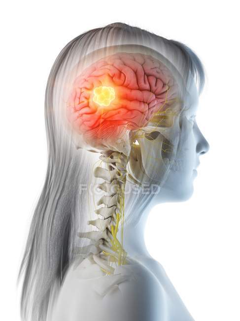 Cancer du cerveau dans le corps féminin, illustration conceptuelle par ordinateur . — Photo de stock