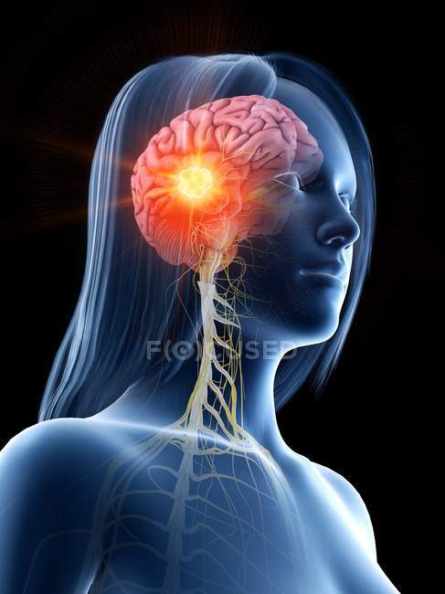 Female body with brain cancer, conceptual digital illustration. — Stock Photo