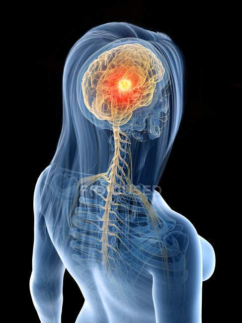 Женское тело с раком мозга, концептуальная цифровая иллюстрация
. — стоковое фото