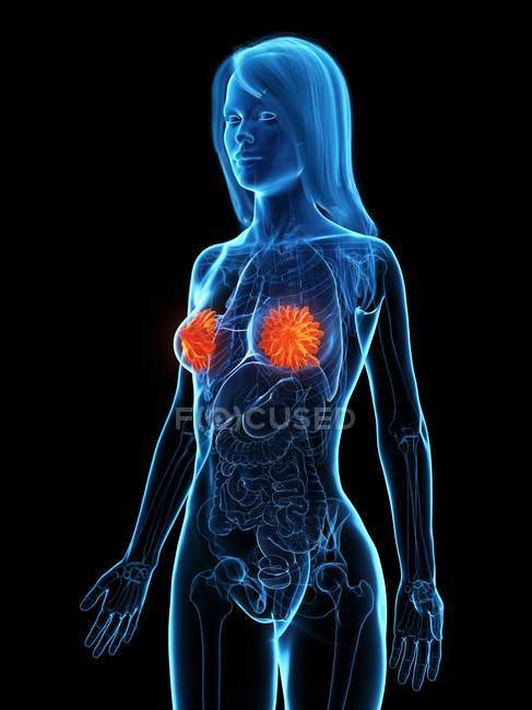 Silueta anatómica femenina con enfermedad de mama, ilustración conceptual por ordenador . - foto de stock