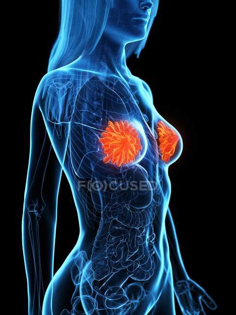 Silueta anatómica femenina con enfermedad de mama, ilustración conceptual por ordenador . - foto de stock
